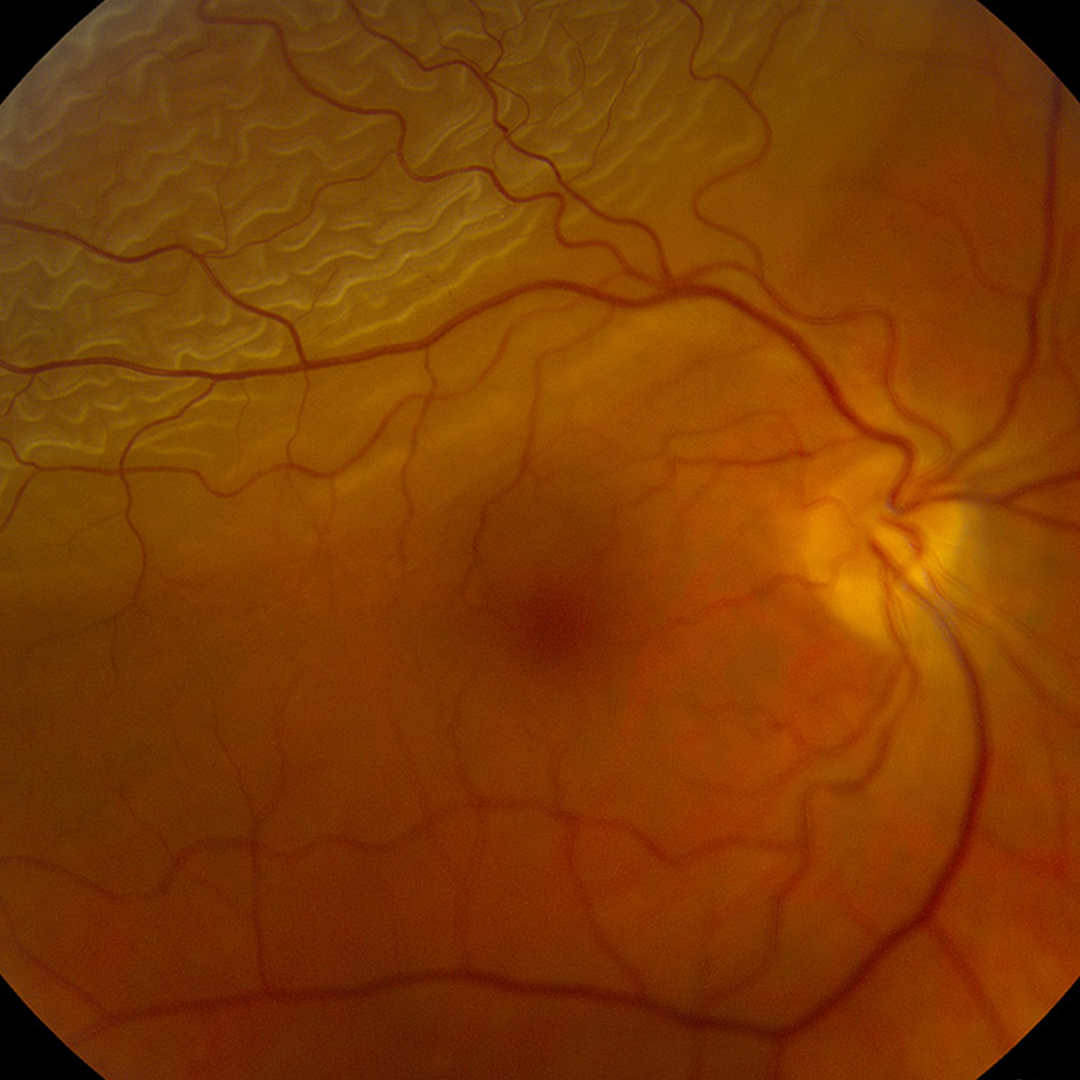 retinal lesion 1 - 1080 x 1080 px